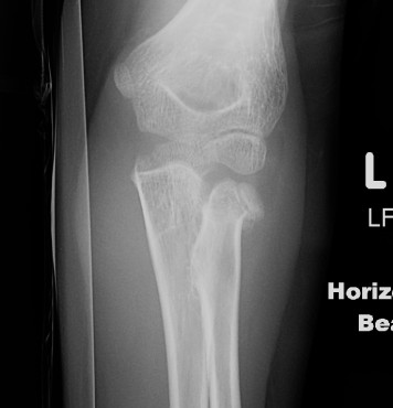 Paediatric Radial Neck Fracture